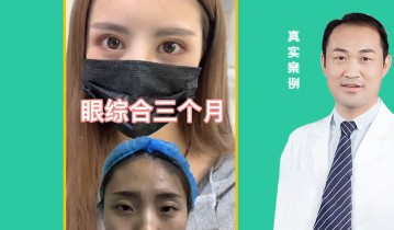 眼综合3个月效果