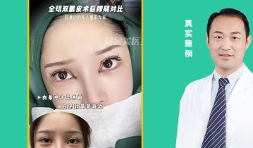 全切双眼皮术后即可对比
