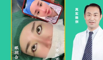 眼综合四项