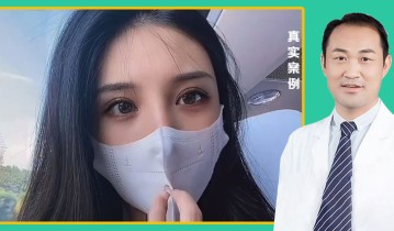 张义医生-黄金媚眼重睑术效果