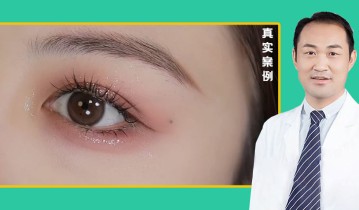 张义医生-眼综合双眼皮效果